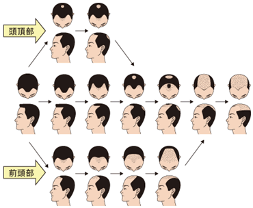 男性型脱毛症（ＡＧＡ）の進行パターン