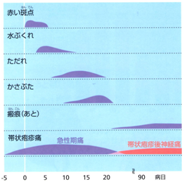 帯状 疱疹 経過